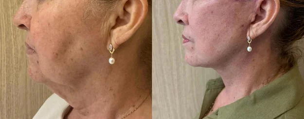 Paciente em recuperação domiciliar assistida — antes e depois