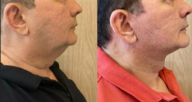 Detalhe das cicatrizes imperceptíveis após a cirurgia — antes e depois