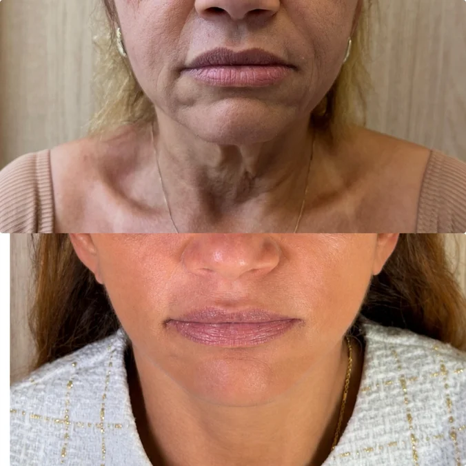 Resultado de facelift endoscópico — terço médio, antes e depois