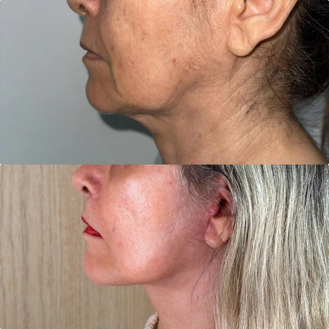 Resultado de contorno mandibular e pescoço, antes e depois