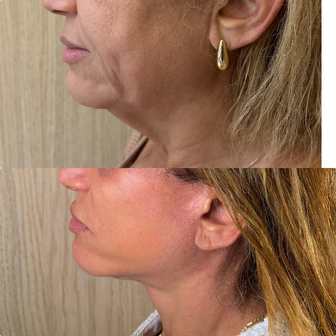 Cicatriz imperceptível após cirurgia — detalhe, antes e depois